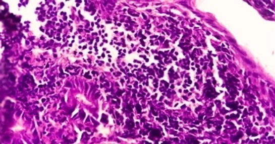 Immuno-Oncology-non-small-cell-lung-cancer