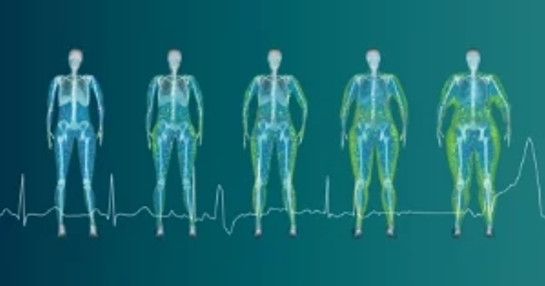 Human body illustration displayed in various stages of obesity.