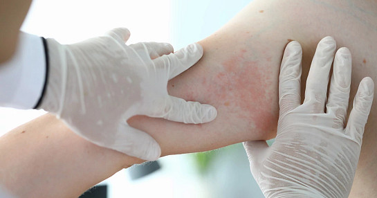 psoriasis skin disease dermatology psoriasis skin disease dermatology
